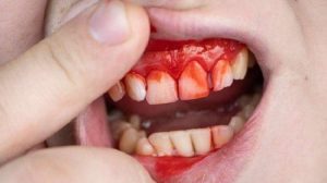 Gusi Berdarah Memahami Penyebab Dan Langkah Langkah Pencegahan Efektif