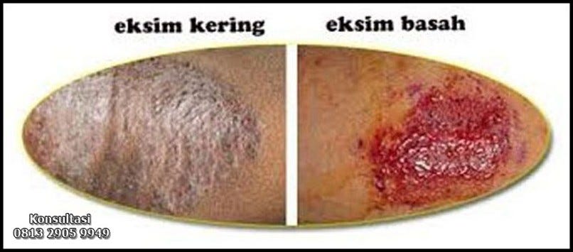 Mengenali Perbedaan Eksim Ringan Dan Serius Panduan Lengkap Untuk Penanganan Yang Tepat